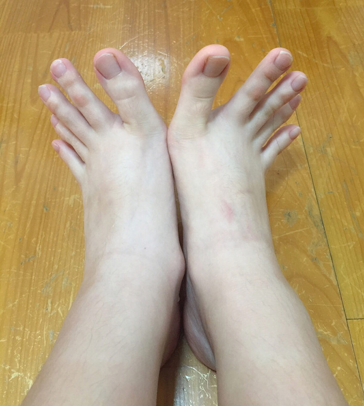 Doigts de pieds orteils trop long 1