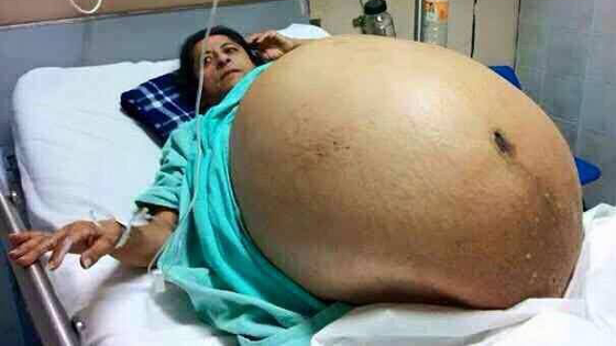 Une indienne accouche de 11 bébés, Incroyable